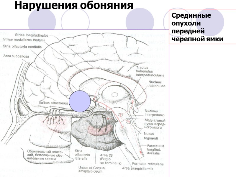 Нарушения обоняния Срединные опухоли передней черепной ямки